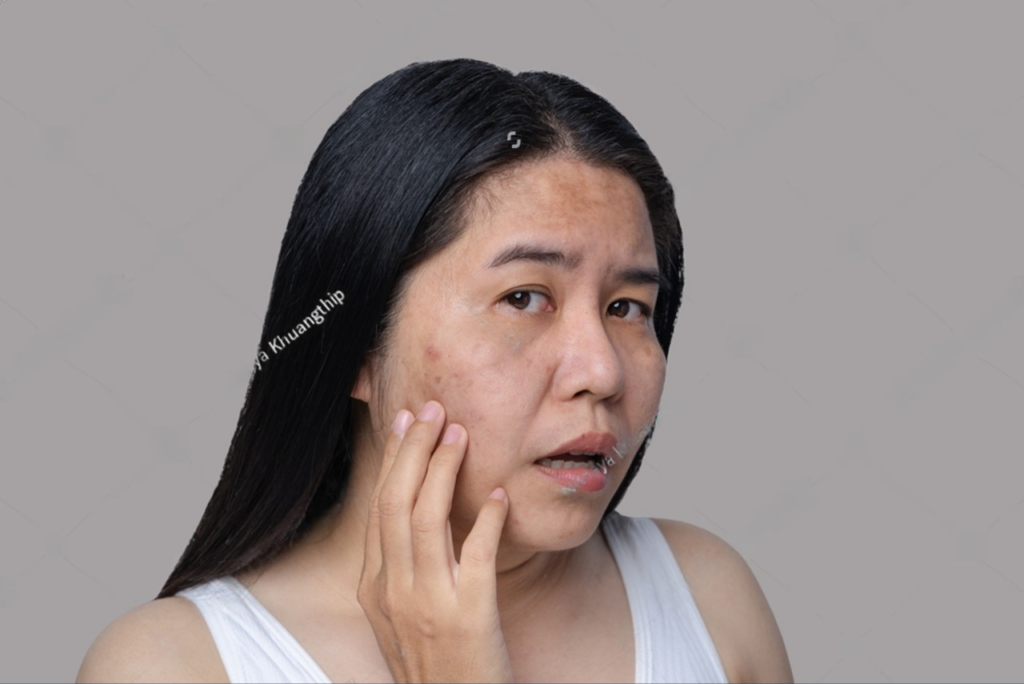 Kerutan sering menjadi masalah kulit yang membuat tampilan wajah kurang sempurna.